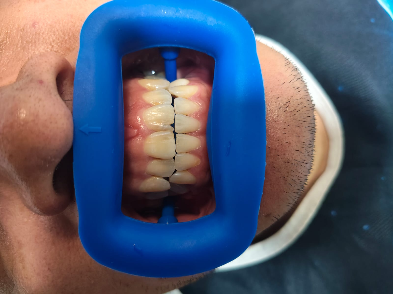 Sonrisa antes del tratamiento odontológico