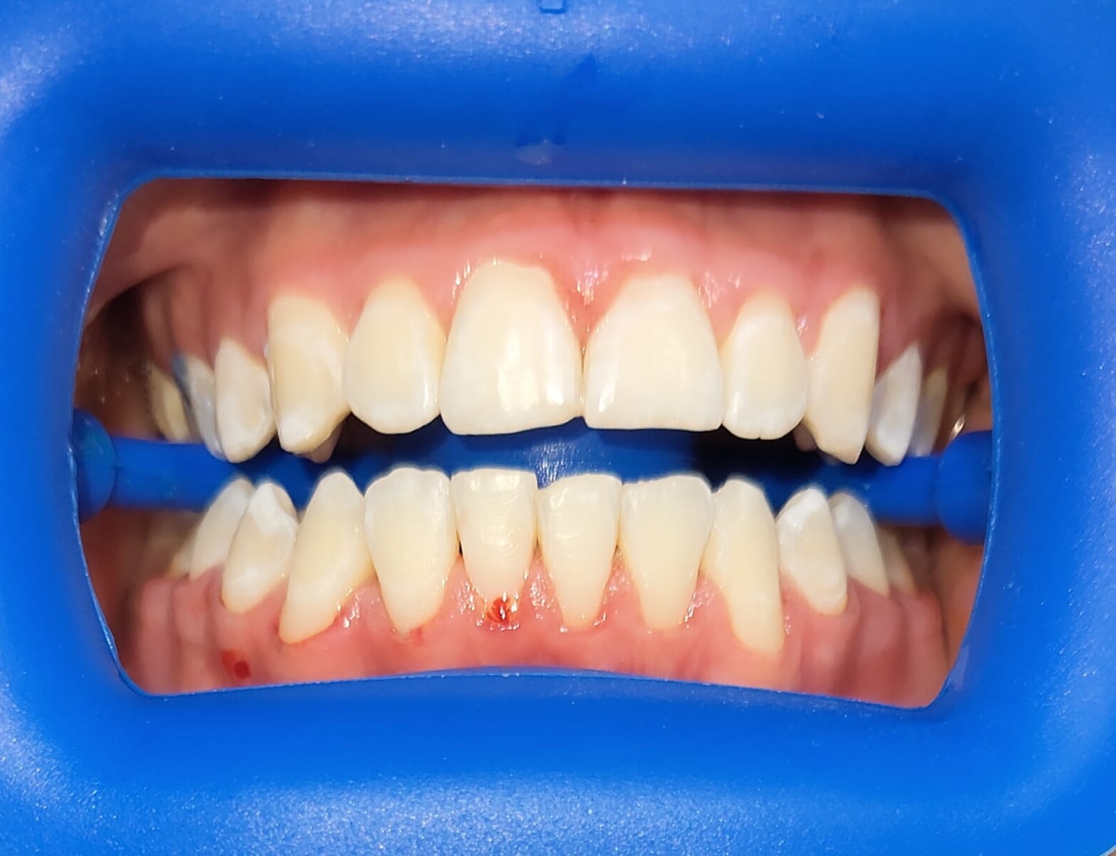 Sonrisa antes del tratamiento odontológico
